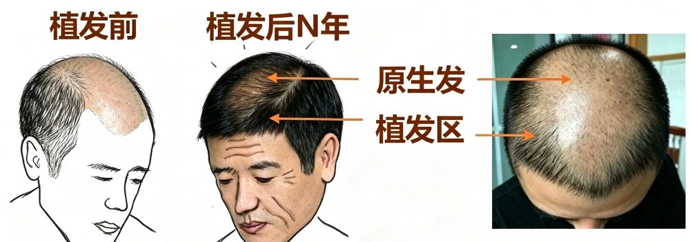 😱 植髮後驚現「月球表面」？頭髮斷層有得救！醫生教路2招KO