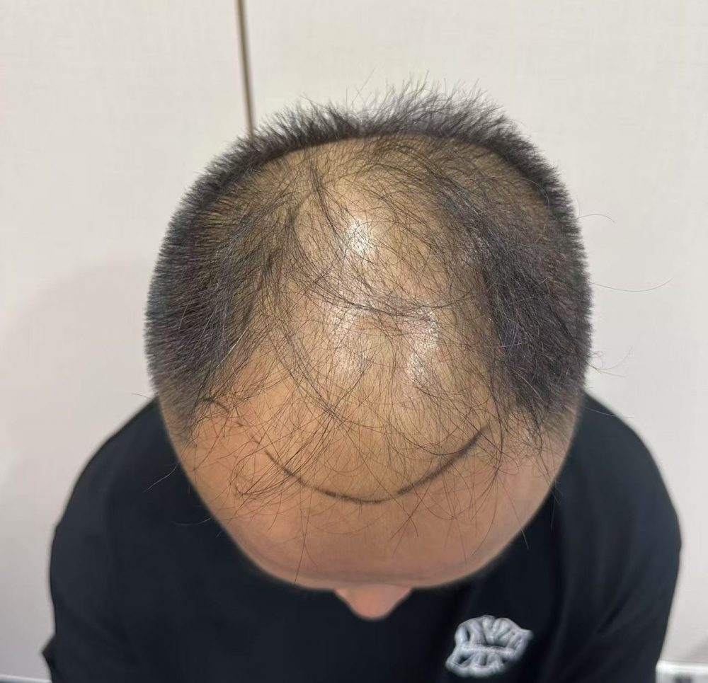 頭頂「地中海」點形成？雄激素性脫髮成因＋香港應對策略