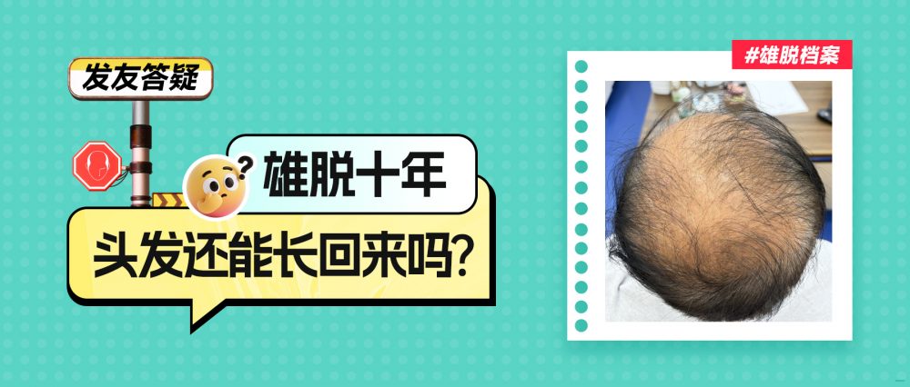 雄脫十年仲有得救？植髮醫生揭秘：唔使淨靠植髮，毛囊有活性就有機會！