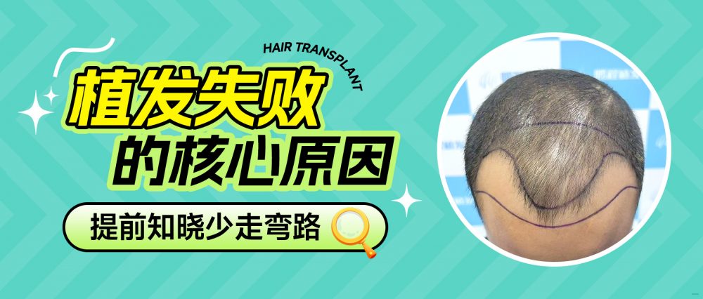植髮後悔？香港髮友必看7大關鍵因素！植髮失敗原因全拆解，避坑不花冤枉錢
