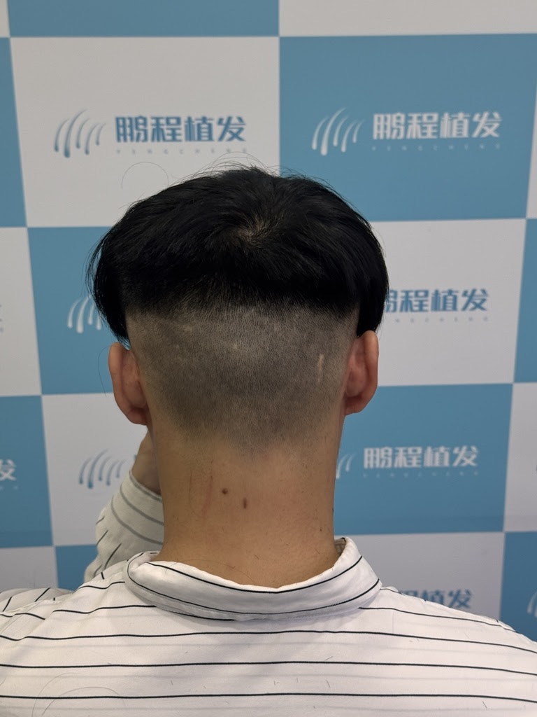 後枕部