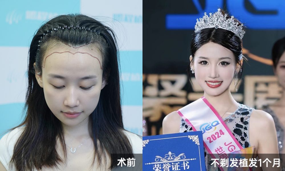女生不剃髮植髮真實案例｜香港美人際線逆齡，術後不尷尬、原生感拉滿｜深圳鵬程植髮