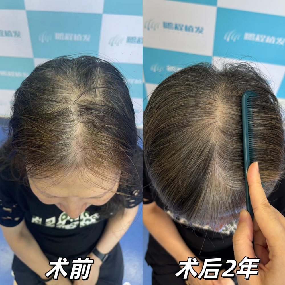 60 歲港籍女士植髮案例｜髪縫稀疏加密，中老年植髮真實效果參考