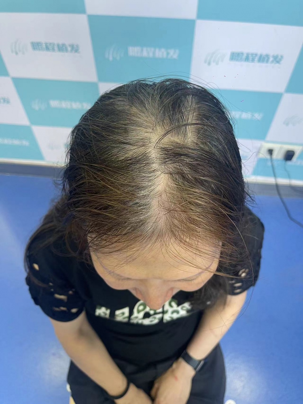 髪縫稀疏