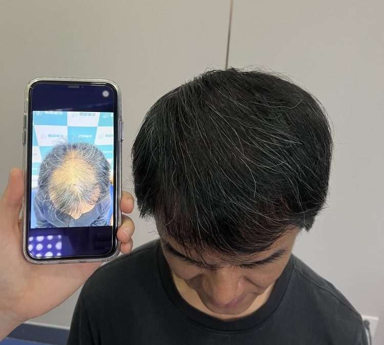香港 45 歲男士植髮案例｜不剃髮植髮頭頂加密 術後 10 個月效果自然
