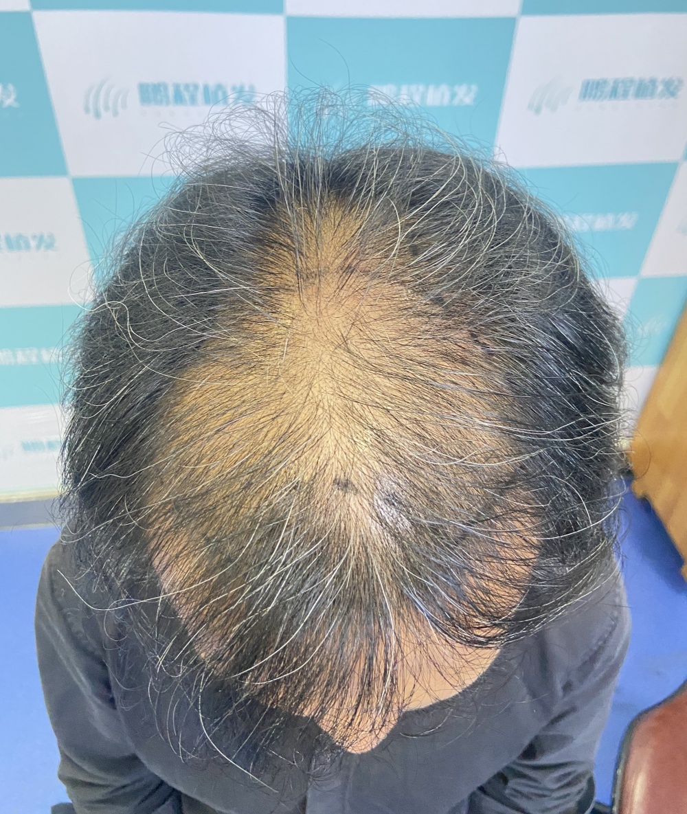 頭頂困局