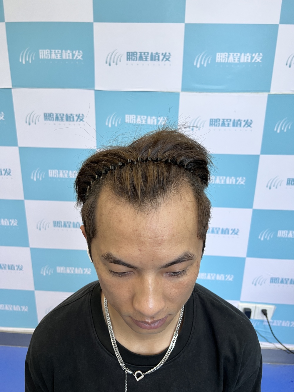 羅先生術前前額M型禿狀態
