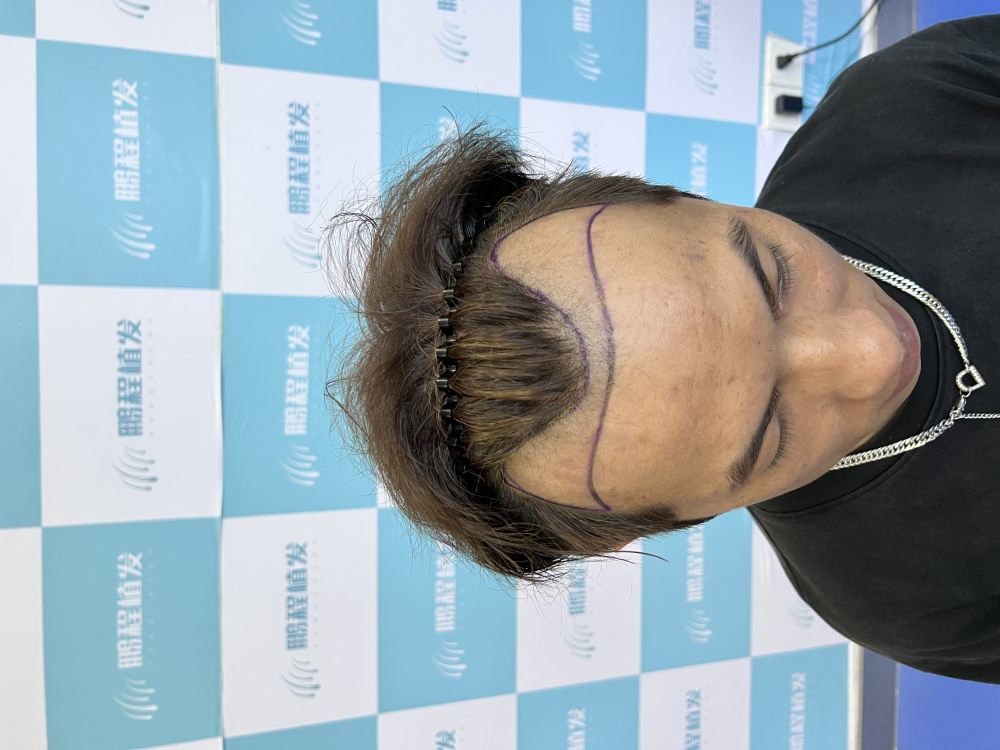 羅先生術前設計髮際線