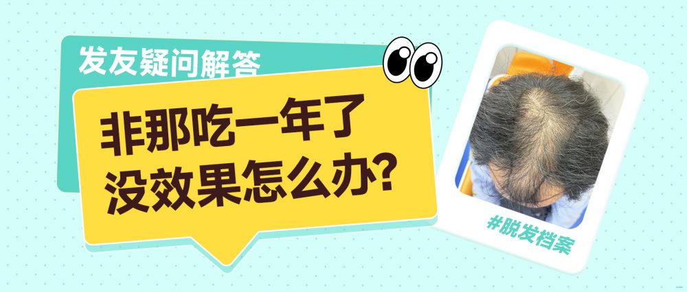 香港脫髮須知｜服食非那雄胺一年無成效？正確處理方法