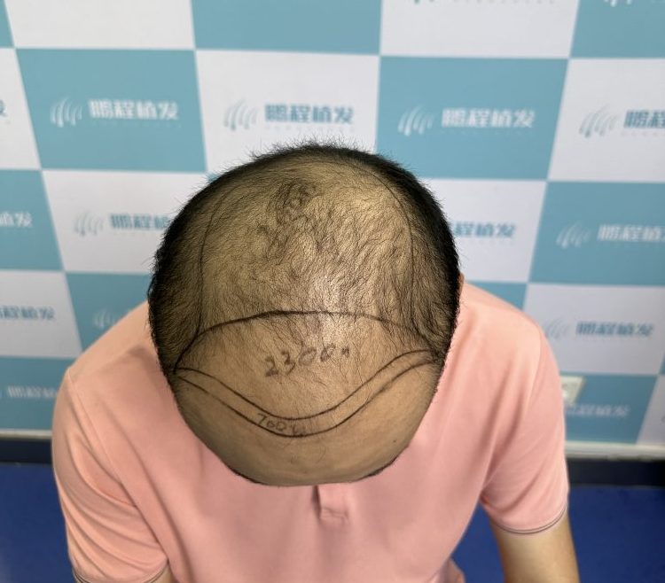 頭髮稀疏