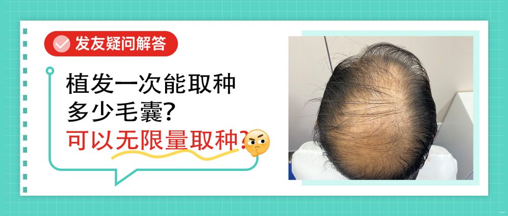 植髮一次可提取多少毛囊單位｜拆解單次植髮數量上限與風險