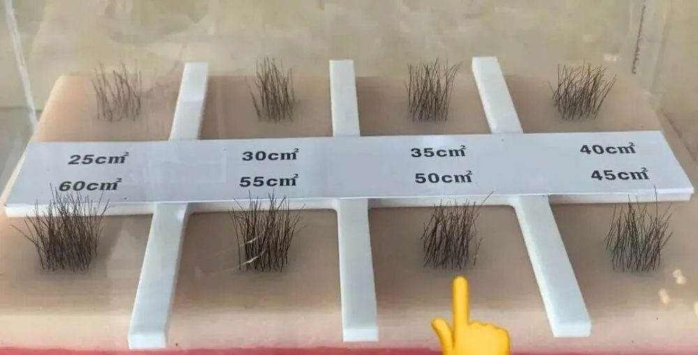 單次植髮上限
