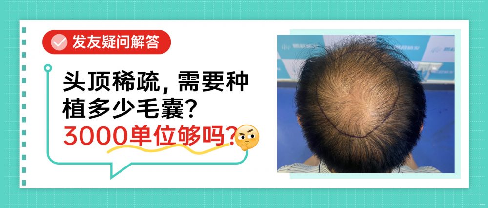 香港植髮｜頭頂稀疏植幾多毛囊？3000 毛囊單位足唔足夠