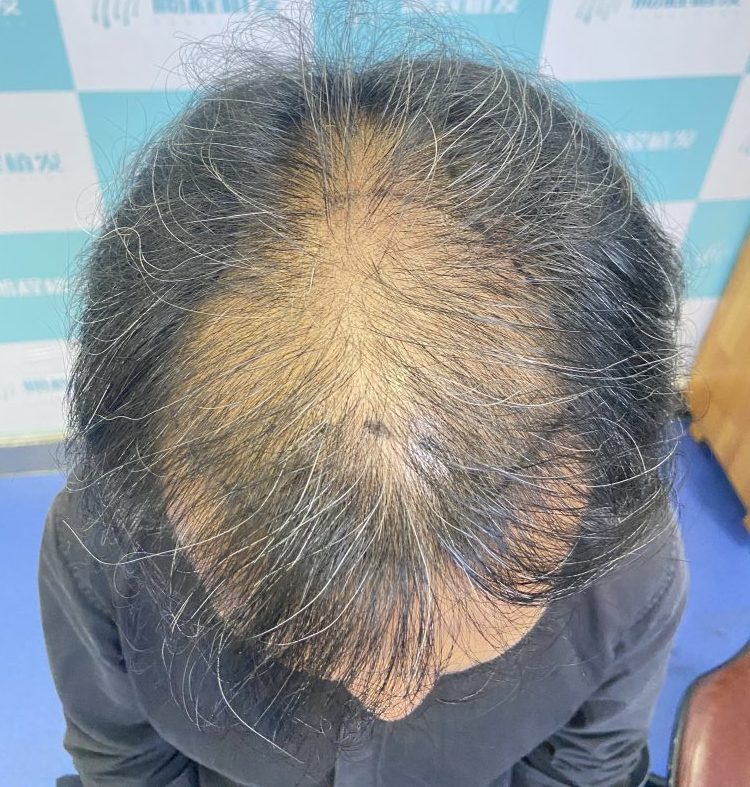五六十歲植髮有年齡上限嗎？香港長者植髮條件及注意事項 | 深圳鵬程植髮