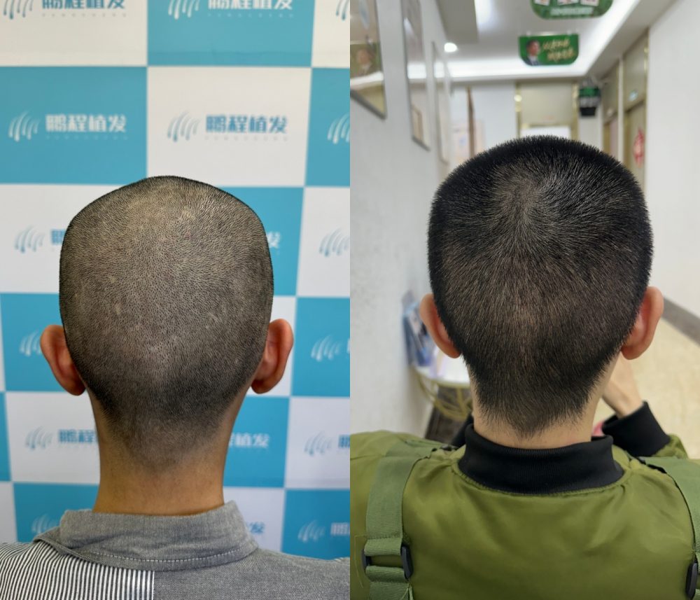 嚇到唔敢植髮？醫生拆解後枕取毛囊真相！後尾枕唔會禿頭㗎✅