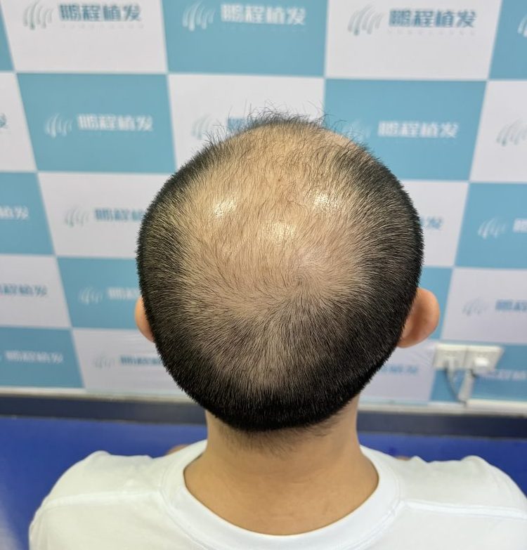 植髮大坑｜頭髮狂脫都想植髮？醫生提醒：呢個時間做百分百後悔