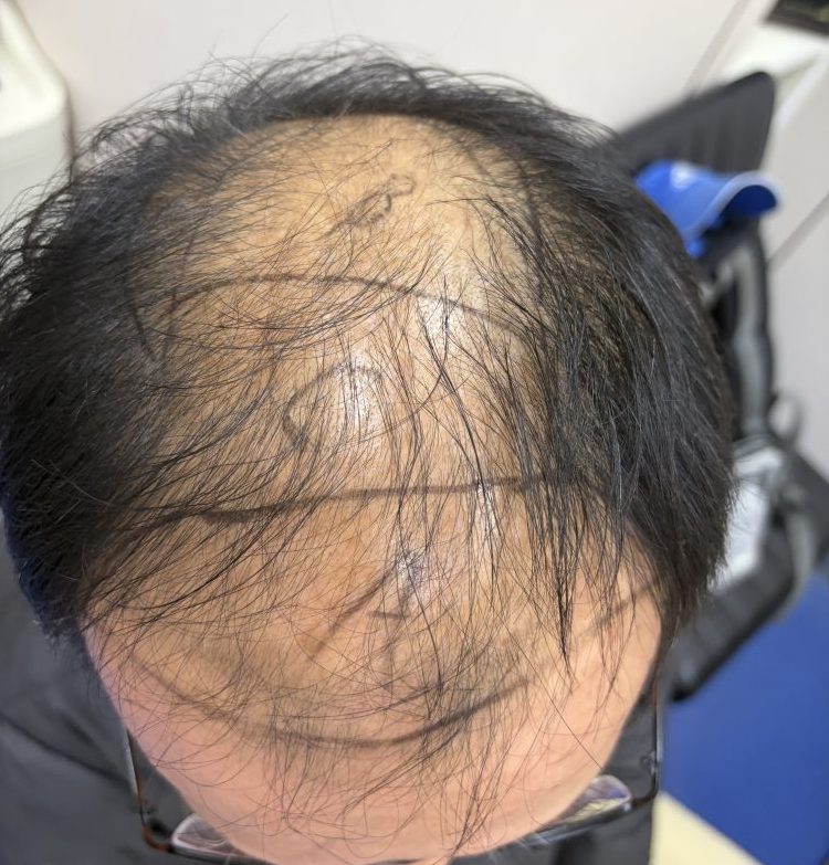 雄性禿5級