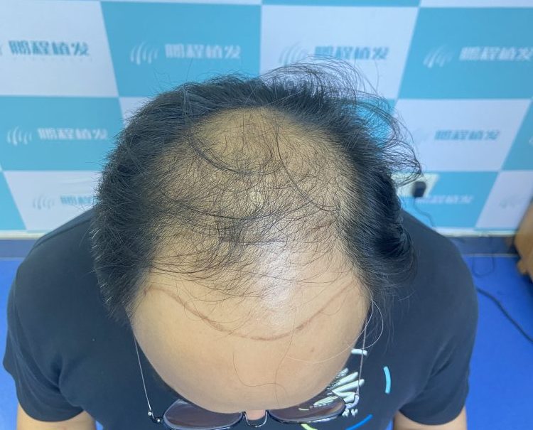 香港頭頂稀疏點算好？加密植髮前必知問題+費用參考