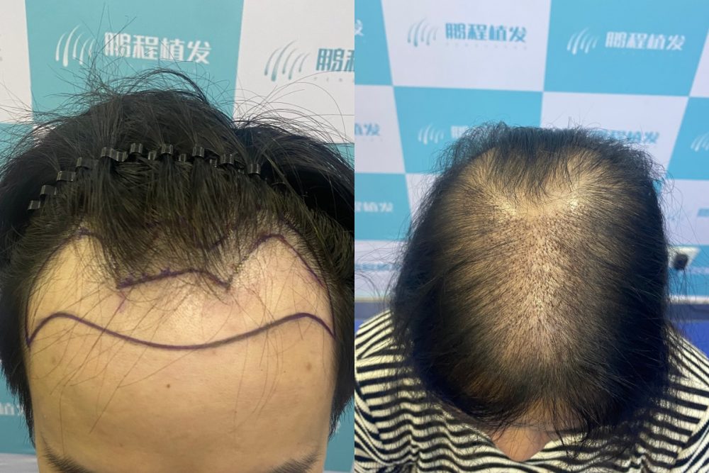 香港男女脫髮位置大不同｜醫生拆解成因＋植髮方案分別