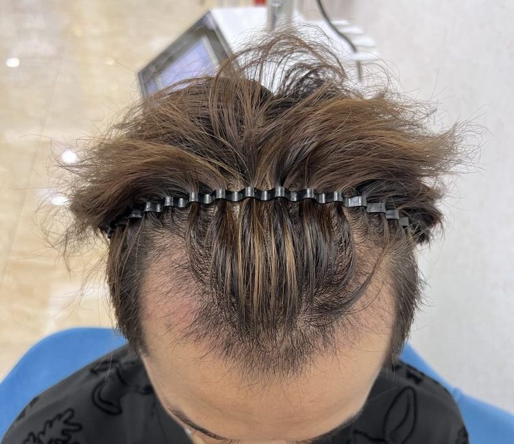 植髮後脫落期好驚慌？30日毛囊炎護理手冊 | 香港髪友必讀