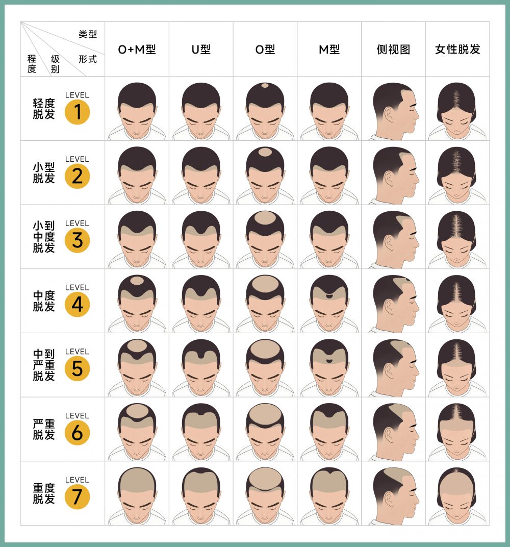 【脫髪救星】植髪時機話你知！医生拆解黃金窗口期，唔想白做就要睇