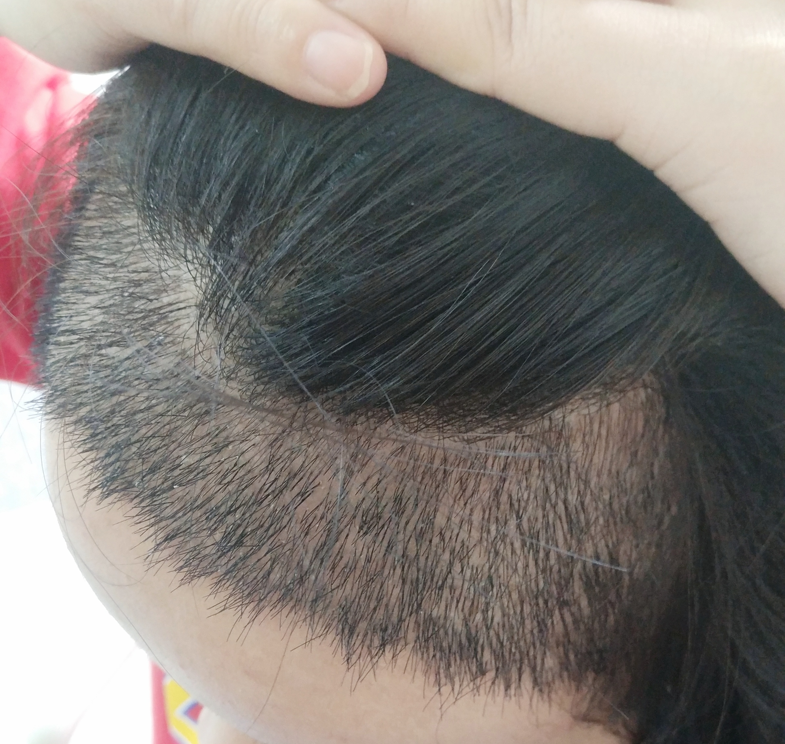 一個人最多可以在深圳做幾次植髮？